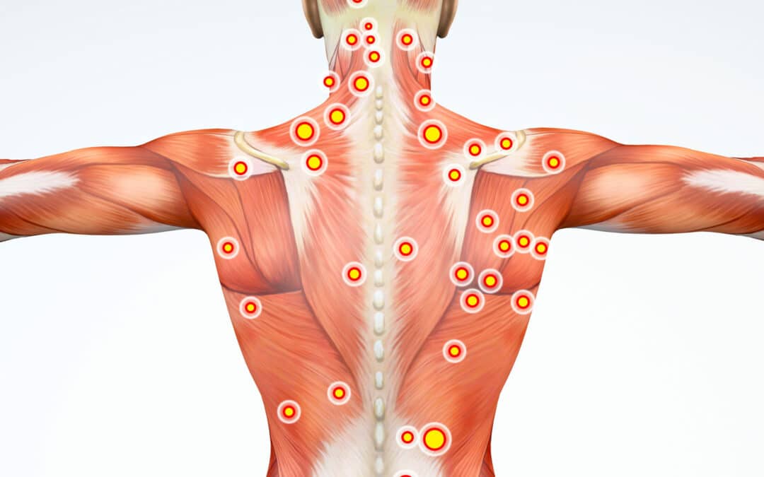 🔗 Chaînes musculaires et trigger points en ostéopathie : comprendre et traiter les douleurs chroniques